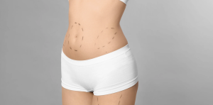 Tummy Tuck Surgery Prices in Fairfax VA